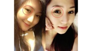 Top10Vn cắt mí mắt đẹp