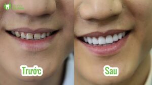 Chí Nhân trám răng đẹp