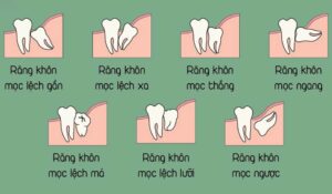 Một số tình trạng mọc răng khôn