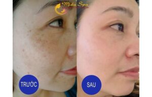 Top10Vn spa trị nám tàn nhang