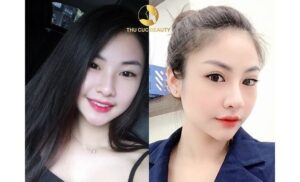 Top10Vn thu gọn cánh mũi đẹp